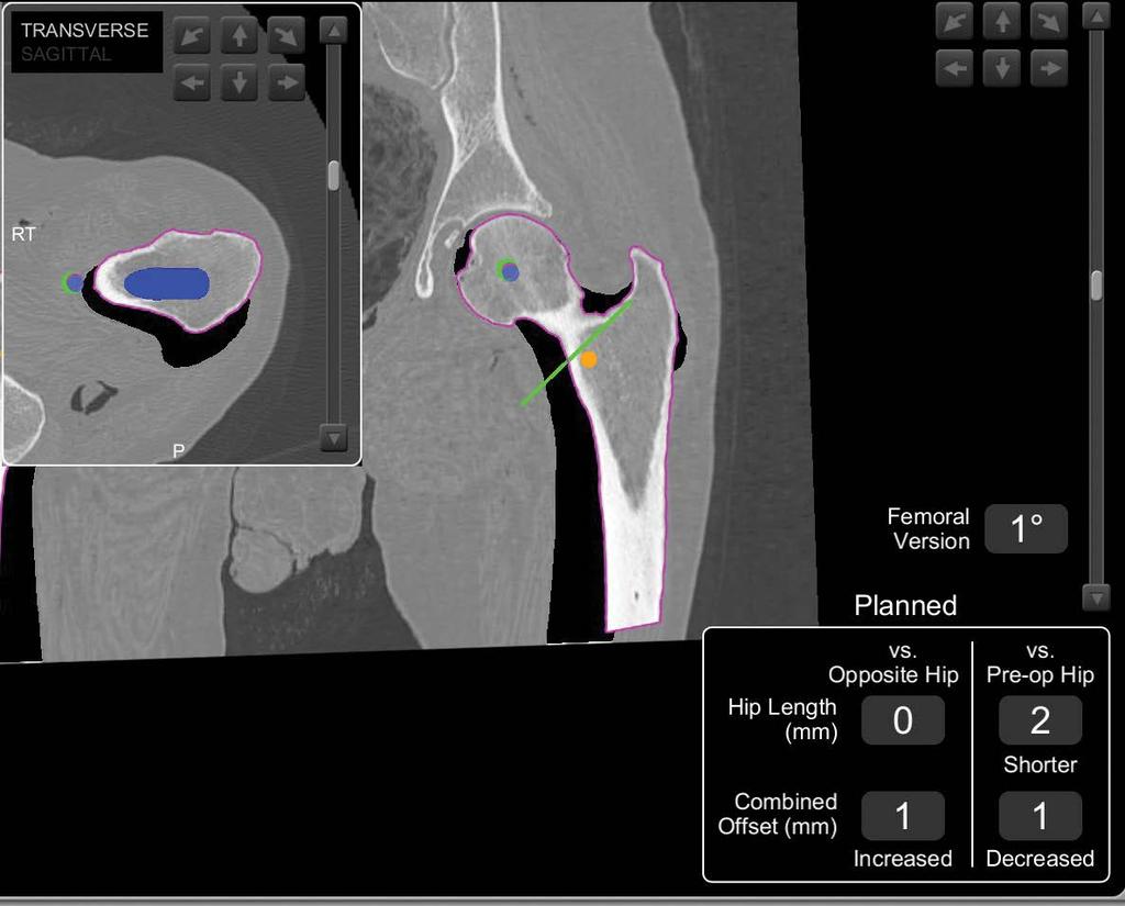 Femoral stem planning Femoral stem size, femoral stem offset, and femoral head lengths can be adjusted on the right side of the screen.