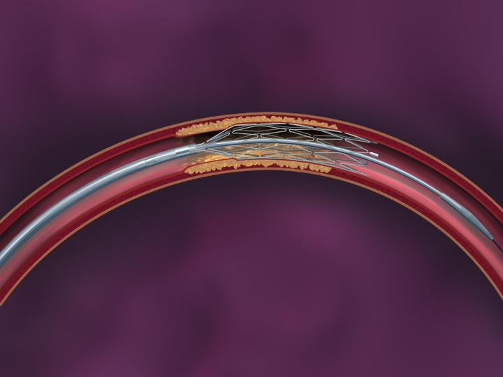Submaximal Stent Placement