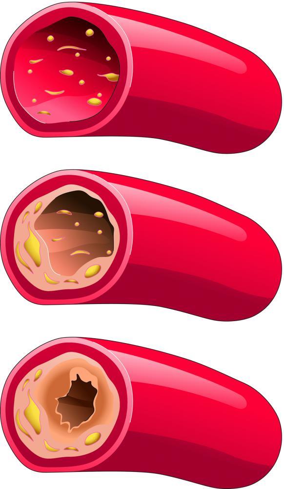 High Cholesterol At risk for high