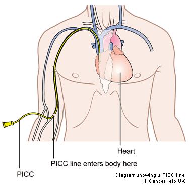 Peripherally Inserted Central Catheters (PICC Lines) Medium Term (2 to 4