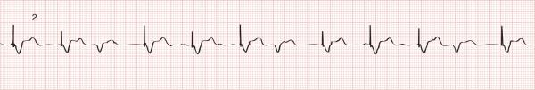 Normal VVI Pacemaker Pacemaker is set at 75 beats/min