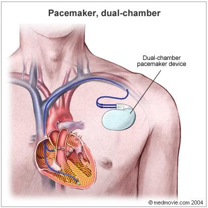 Failure to Sense Constant pacemaker spikes despite intrinsic cardiac activity Common Causes Lead