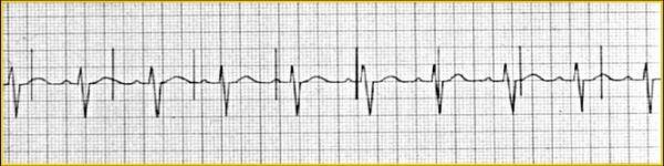 Failure to Capture Appropriate pacemaker spikes without subsequent cardiac activity Common Causes Lead