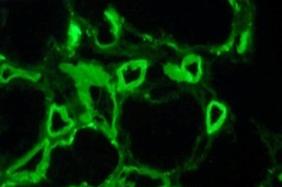 Antibody mediated rejection Microcirculation inflammation, C4d staining Effector T cells home to