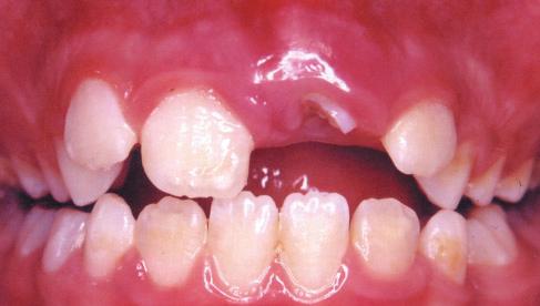 Figure 1. Intraoral view of the severely intruded left central maxillary incisor (tooth no. 9) 3 days after trauma. Notice the swelling of the gingiva around this tooth.