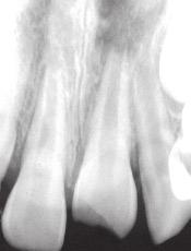 2 It was also suggested that delay in applying extrusive forces on the tooth might increase the likelihood of developing ankylosis in the intruded position.