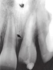 clinical confirmation by an endodontic file, the canal was obturated by gutta percha (GC Dental Industrial Corp, Tokyo, Japan) and root canal sealer (AH-26).