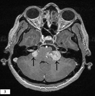 extra-axial lesions at cerebello-pontine angle (arrows). MRI study of the brain and spine performed on 1.