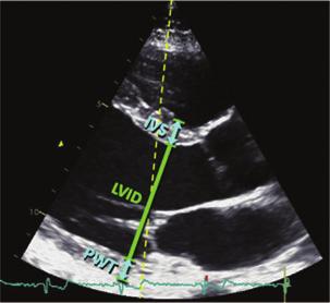 6 g Where IVS is interventricular septum; LVID is LV internal diameter, and PWT is inferolateral wall thickness.