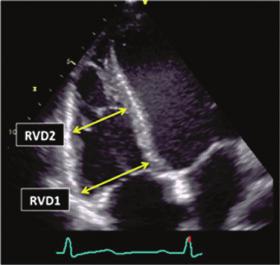 250 R.M. Lang et al. Table 7 Recommendations for the echocardiographic assessment of RV size Echocardiographic imaging Recommended methods Advantages Limitations.