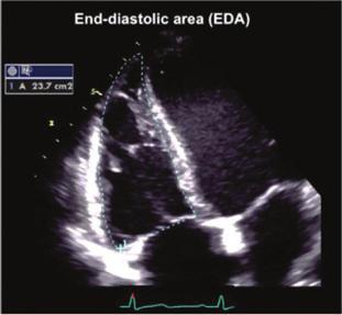 junction (in parasternal long-axis view) or to the aortic valve (in parasternal short-axis) at end-diastole Distal RV outflow diameter (RVOT distal) ¼ linear transversal dimension measured just