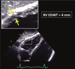 Recommendations for Cardiac Chamber Quantification by Echocardiography in Adults 251 Table 7 Continued Echocardiographic imaging Recommended methods Advantages Limitations.
