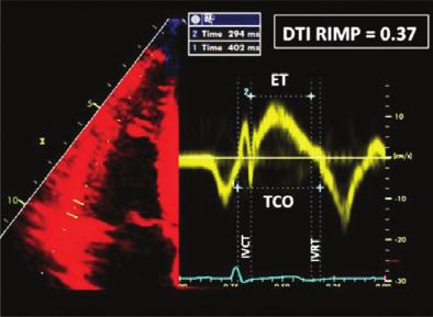 .. RV global function Prognostic value Pulsed Doppler RIMP RIMP (Tei index) by pulsed Doppler: RIMP ¼ (TCO 2 ET)/ET Less affected by heart rate Requires matching