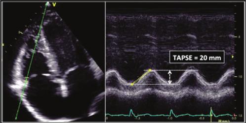 Recommendations for Cardiac Chamber Quantification by Echocardiography in Adults 253 Table 9 Continued Echocardiographic imaging Recommended methods Advantages Limitations.