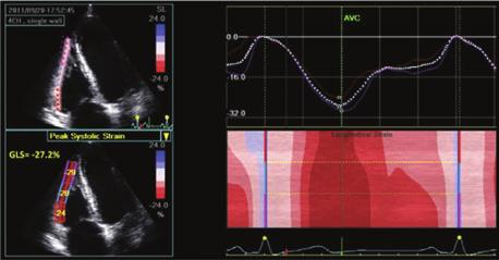 Color tissue Doppler S wave GLS Peak systolic velocity of tricuspid annulus by color DTI (cm/sec) Peak value of 2D longitudinal speckle tracking derived strain, averaged over the three segments of