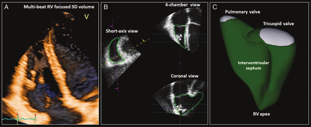 Recommendations for Cardiac Chamber Quantification by Echocardiography in Adults 255 Figure 8 Three-dimensional analysis of the right ventricle (RV).