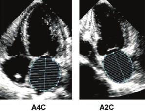 Endocardial tracing should exclude atrial appendage and pulmonary veins.