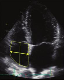 Recommendations for Cardiac Chamber Quantification by Echocardiography in Adults 261 Table 12 Recommendations for the echocardiographic assessment of RA size Parameter and method Echocardiographic