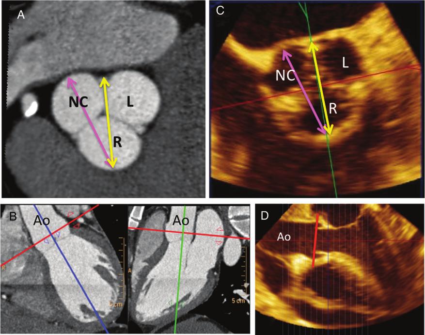 Recommendations for Cardiac Chamber Quantification by Echocardiography in Adults 263 Figure 11 The smaller (antero-posterior, sagittal) aortic root diameter is measured using CT (A) or 3D TEE (C,