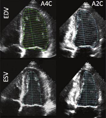 dimension, i.e., parasternal long-axis view carefully representative only in obtained perpendicular to the LV long normally shaped axis, and measured at the level of the ventricles mitral valve leaflet tips.