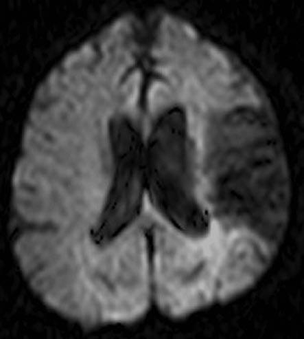 Singapore Med Med J 2006; J 2006; 47(3) 47(3) : 200 : 3 1a weeks till twelve months) for residual neurological deficits. Follow-up imaging was not performed. 1b Fig. 1 Case 1.