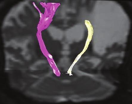 (b) MR tractography shows complete disruption of left corticospinal tract at the level of infarction with small calibre of the rest of the tract.
