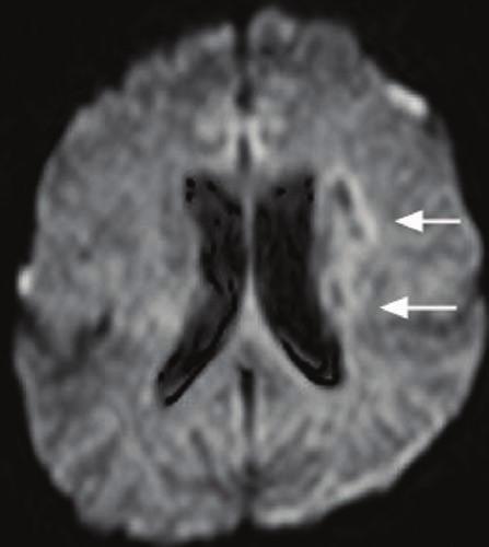 Singapore Med Med J 2006; J 2006; 47(3) 47(3) : 201 : 4 2a 3a 2b 3b Fig. 2 Case 2. (a) DWI shows left cortical and subcortical chronic infarction (arrows).