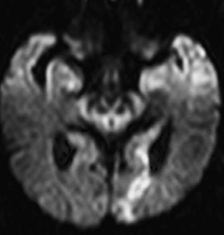 On clinical follow-up, the patients with disrupted white matter tracts (three with ischaemic infarcts and one with haemorrhagic infarct) continued to have residual neurological deficits.