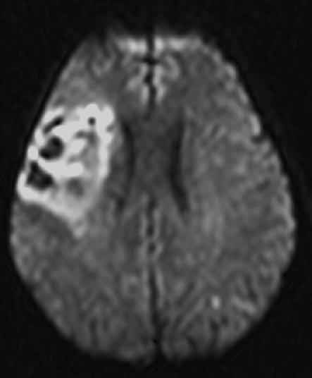 Singapore Med Med J 2006; J 2006; 47(3) 47(3) : 202 : 5 4a 5a 4b 5b Fig. 4 Case 4. (a) DWI shows right middle cerebral artery infarction with haemorrhagic conversion.