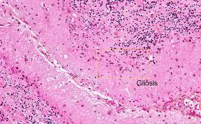 Gliosis simply means increased glial cells think of
