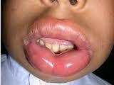 IgE-mediated: Gastrointestinal UPPER GIT Angioedema of the lips,