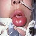 IgE-mediated: Anaphylaxis Acute life-threatening allergic reaction, typically