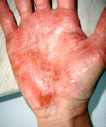 Non-IgE-mediated: contact dermatitis Caused by cell-mediated allergic reactions to chemical