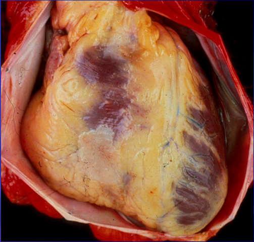 External Cardiac Anatomy Pericardium