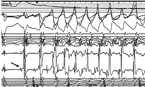 recurrent ventricular tachycardia by electrical isolation of