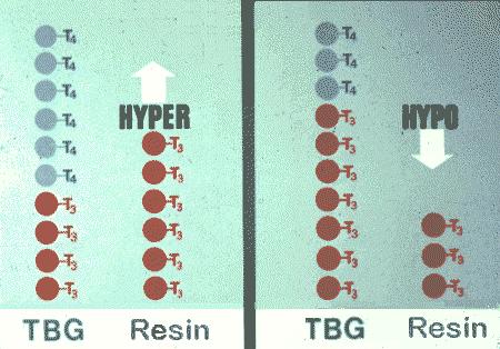 Hyperthyroid cases exhibit a decreased concentration of unoccupied TBG sites and an increased T3