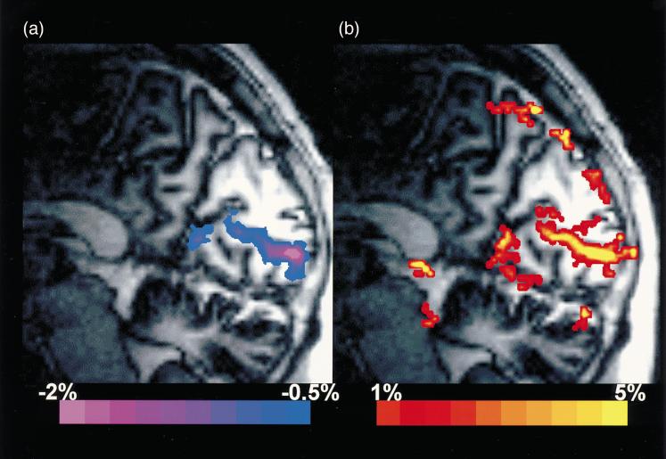 12 FUNCTIONAL MRI AT HIGH FIELDS: PRACTICE AND UTILITY Figure 11 Functional images of visual stimulation constructed from (a) the early negative response (color coded in blue) and (b) the peak of the