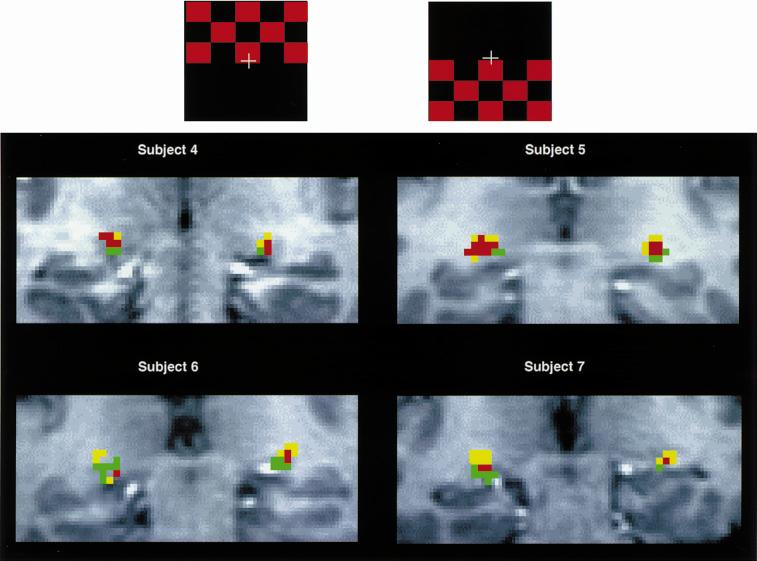 FUNCTIONAL MRI AT HIGH FIELDS: PRACTICE AND UTILITY 13 Figure 13 High-resolution fmri mapping of lateral geniculate nucleus activation during the upper- eld and lower- eld red/black checkerboard