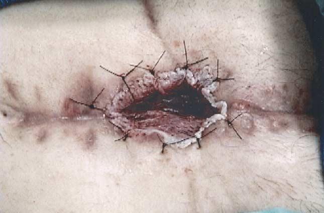 Ann Thorac Surg ALLIE ET AL 2004;78:673 8 BIOENGINEERED APLIGRAF 675 Fig 2. Apligraf application. Outpatient weekly dressing changes, wound evaluations, and wound care were instituted.