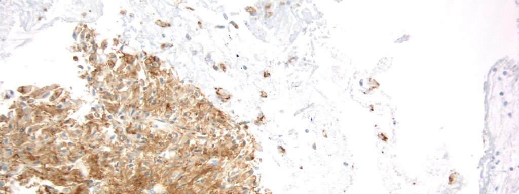 Cellient Cell Block: CEA Stain