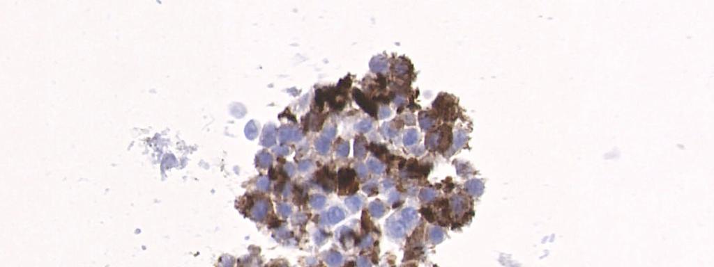 Cellient Cell Block: Calcitonin Stain Positive calcitonin
