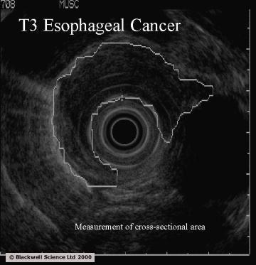 Evaluation of the Esophageal Mass High quality endoscopy Defines the anatomic esophagogastric junction Describes the