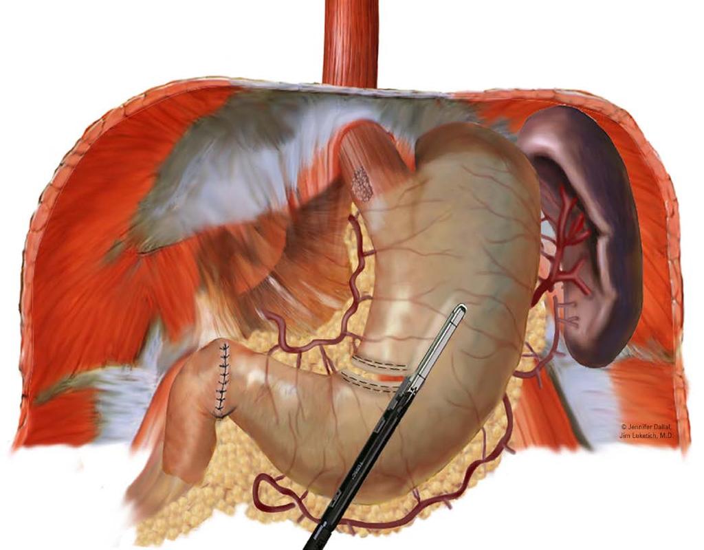 Laparoscopic Steps: Gastric Tubularization, Celiac node dissection,