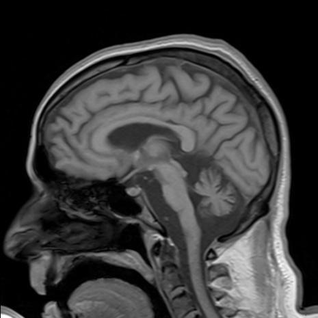 Axial T2WI Figure 2: T2WI- upper medulla- loss of normal olivary bulge on anterolateral aspect of medulla PRESENTATION OF CASE 58 year old normotensive, nondiabetic male came with case of