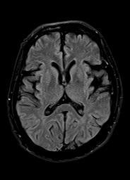 symptoms with prominence of rigidity, with neuroimaging and gross pathology showing atrophy of the striatum as a result of neuronal loss, involving putamen more than caudate.