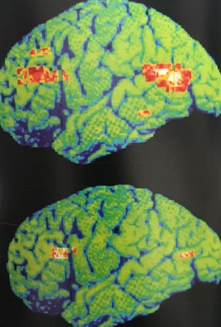 Psychiatry On the Horizon Imaging Biomarkers -CRP, IL-6, TNF-α Glutamate - ketamine Glial Cells PET Scan: depressed brain (top),