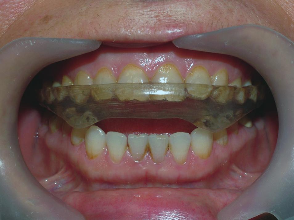 Occlusal adjustment was made in the mouth, and the following day the patient was checked for the splint adaptation and evaluated so as to see if any problems occured (Figures 8, 9).