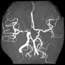 56 had a cerebral vasculopathy 6 overt stroke abnormal TCD without stroke with abnormal conventional arteriography or MRA(n=6) or with normal angiography but persistent abnormal TCD despite chronic