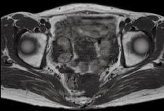 : The tumor ws strongly dhered to the rectum nd the left nterior scrum, nd severe dhesion nd/ or invsion ws suspected.