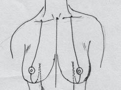 The scar also has a tendency to keep pulling the breast tissue downwards [Diagram 7].